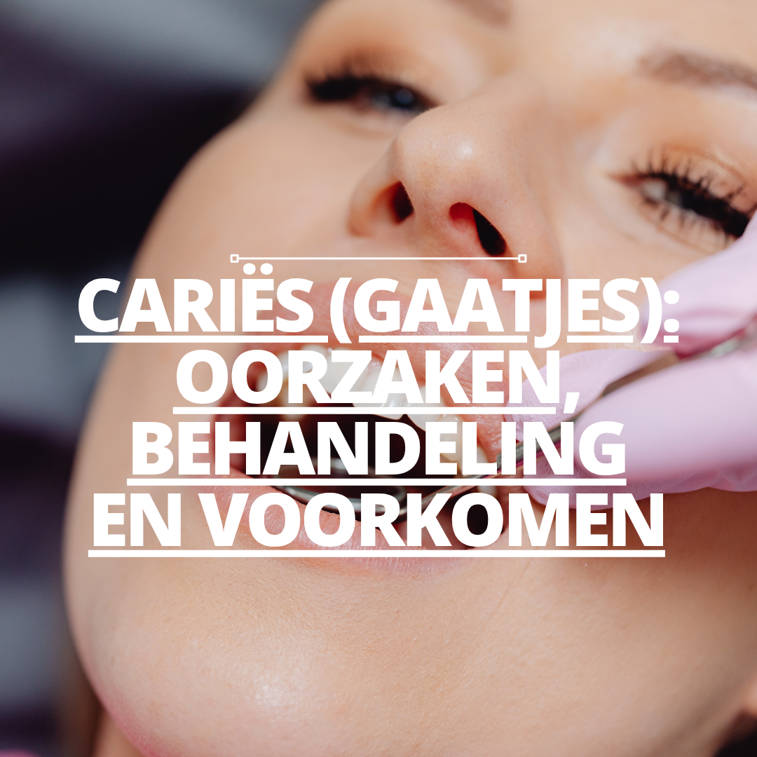 Cariës (Gaatjes): Oorzaken, behandeling en voorkomen