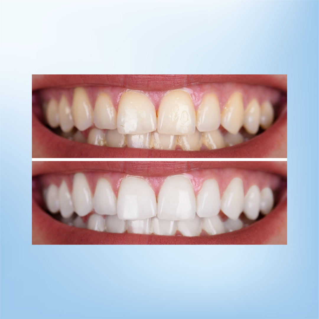 Crest 3D Whitening Strips Professional Effect Luxe