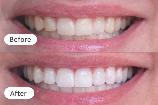 Behoorlijk verkleurde tanden