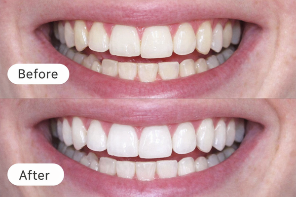 Geen pijnscheuten meer!