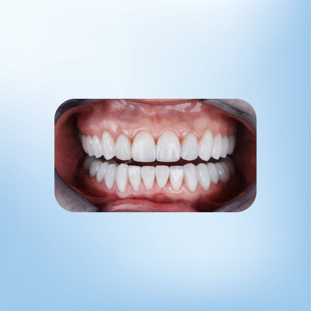 Crest Whitening Bundel