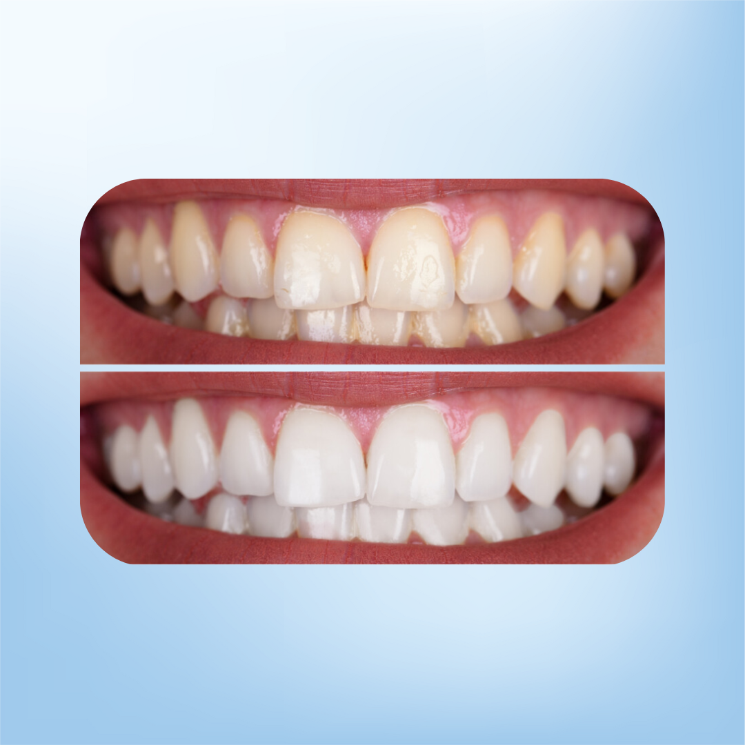 Crest Whitening Bundel