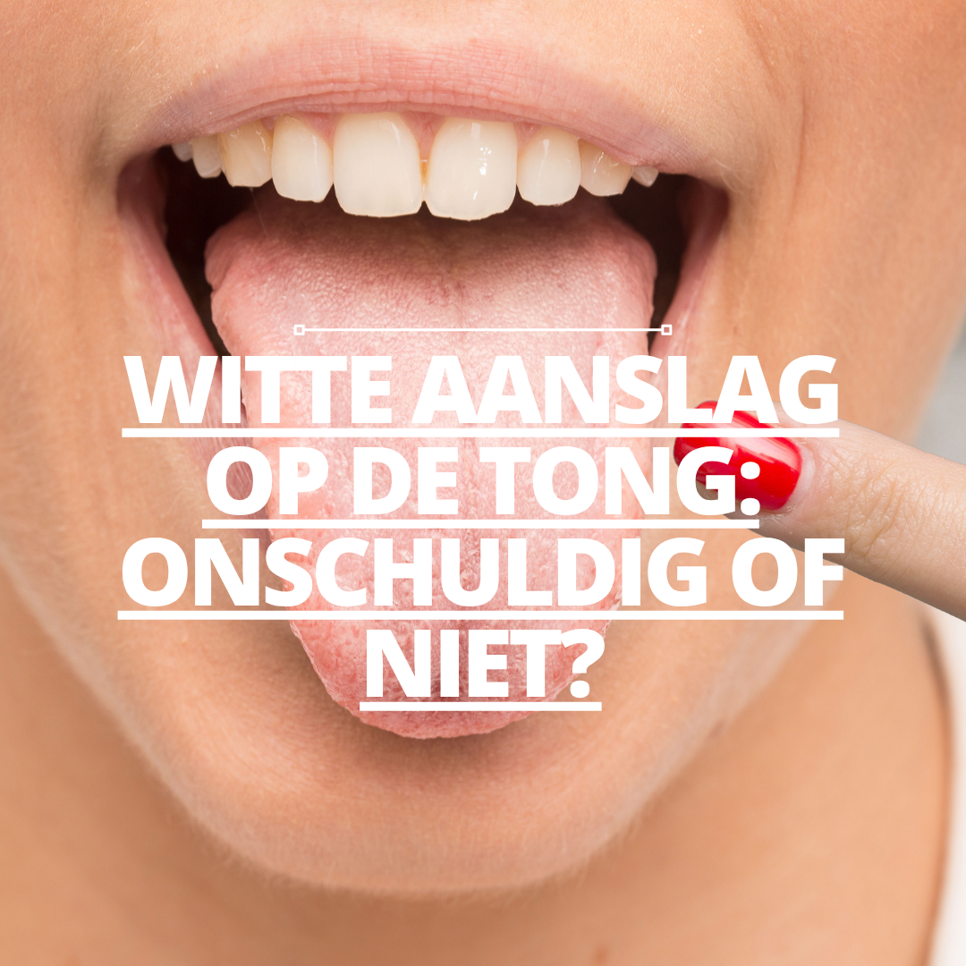 Witte aanslag op de tong: onschuldig of niet?
